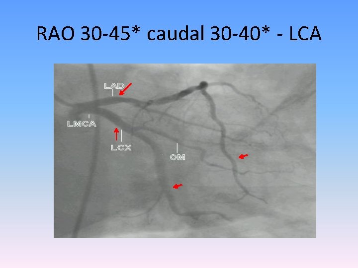 RAO 30 -45* caudal 30 -40* - LCA 