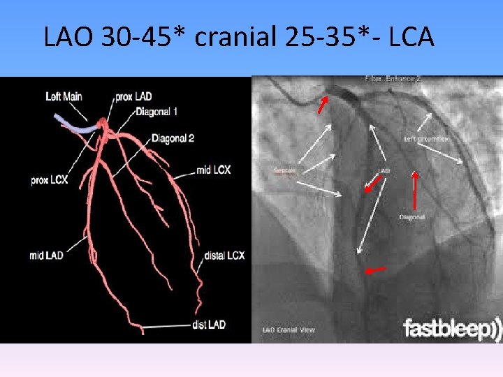 LAO 30 -45* cranial 25 -35*- LCA 