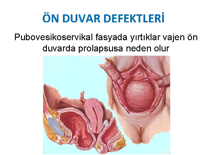 ÖN DUVAR DEFEKTLERİ Pubovesikoservikal fasyada yırtıklar vajen ön duvarda prolapsusa neden olur ÖN DUVAR DEFEKTLERİ Pubovesikoservikal fasyada yırtıklar vajen ön duvarda prolapsusa neden olur