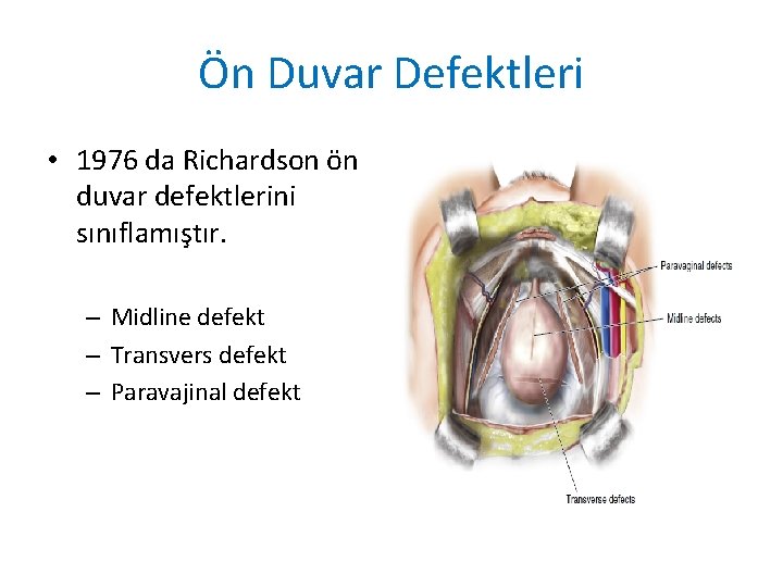 Ön Duvar Defektleri • 1976 da Richardson ön duvar defektlerini sınıflamıştır. – Midline defekt Ön Duvar Defektleri • 1976 da Richardson ön duvar defektlerini sınıflamıştır. – Midline defekt