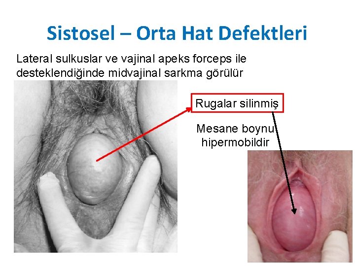 Sistosel – Orta Hat Defektleri Lateral sulkuslar ve vajinal apeks forceps ile desteklendiğinde midvajinal Sistosel – Orta Hat Defektleri Lateral sulkuslar ve vajinal apeks forceps ile desteklendiğinde midvajinal