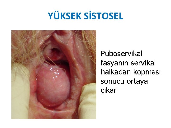 YÜKSEK SİSTOSEL Puboservikal fasyanın servikal halkadan kopması sonucu ortaya çıkar YÜKSEK SİSTOSEL Puboservikal fasyanın servikal halkadan kopması sonucu ortaya çıkar