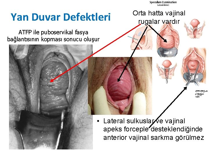 Yan Duvar Defektleri Orta hatta vajinal rugalar vardır ATFP ile puboservikal fasya bağlantısının kopması Yan Duvar Defektleri Orta hatta vajinal rugalar vardır ATFP ile puboservikal fasya bağlantısının kopması