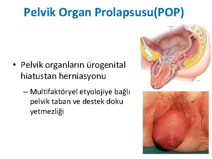 Pelvik Organ Prolapsusu(POP)) • Pelvik organların ürogenital hiatustan herniasyonu – Multifaktöryel etyolojiye bağlı pelvik Pelvik Organ Prolapsusu(POP)) • Pelvik organların ürogenital hiatustan herniasyonu – Multifaktöryel etyolojiye bağlı pelvik