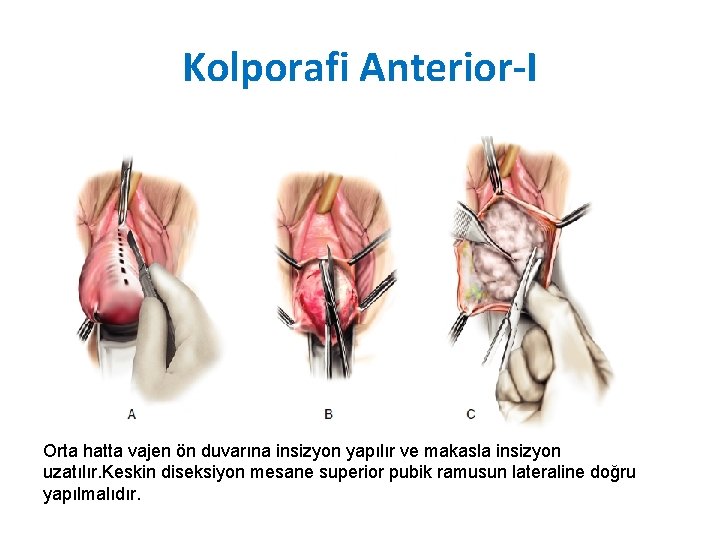 Kolporafi Anterior-I Orta hatta vajen ön duvarına insizyon yapılır ve makasla insizyon uzatılır. Keskin Kolporafi Anterior-I Orta hatta vajen ön duvarına insizyon yapılır ve makasla insizyon uzatılır. Keskin
