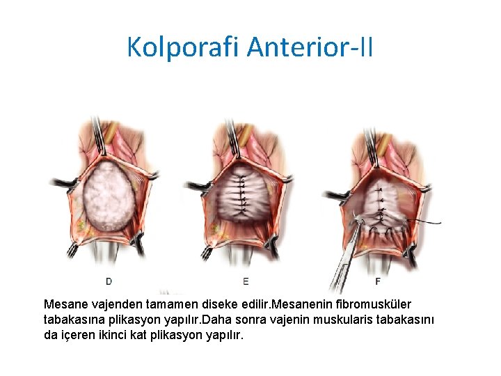 Kolporafi Anterior-II Mesane vajenden tamamen diseke edilir. Mesanenin fibromusküler tabakasına plikasyon yapılır. Daha sonra Kolporafi Anterior-II Mesane vajenden tamamen diseke edilir. Mesanenin fibromusküler tabakasına plikasyon yapılır. Daha sonra