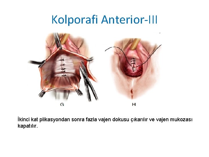 Kolporafi Anterior-III İkinci kat plikasyondan sonra fazla vajen dokusu çıkarılır ve vajen mukozası kapatılır. Kolporafi Anterior-III İkinci kat plikasyondan sonra fazla vajen dokusu çıkarılır ve vajen mukozası kapatılır.