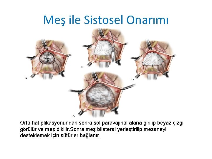 Meş ile Sistosel Onarımı Orta hat plikasyonundan sonra, sol paravajinal alana girilip beyaz çizgi Meş ile Sistosel Onarımı Orta hat plikasyonundan sonra, sol paravajinal alana girilip beyaz çizgi