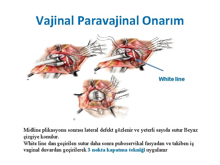 Vajinal Paravajinal Onarım White line Midline plikasyonu sonrası lateral defekt gözlenir ve yeterli sayıda Vajinal Paravajinal Onarım White line Midline plikasyonu sonrası lateral defekt gözlenir ve yeterli sayıda