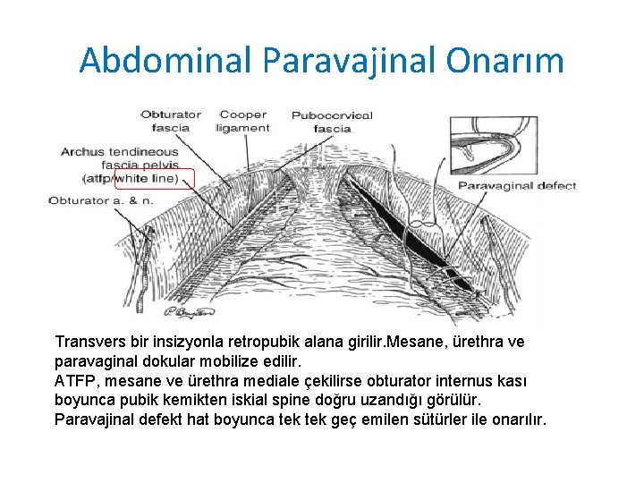 Abdominal Paravajinal Onarım Transvers bir insizyonla retropubik alana girilir. Mesane, ürethra ve paravaginal dokular Abdominal Paravajinal Onarım Transvers bir insizyonla retropubik alana girilir. Mesane, ürethra ve paravaginal dokular