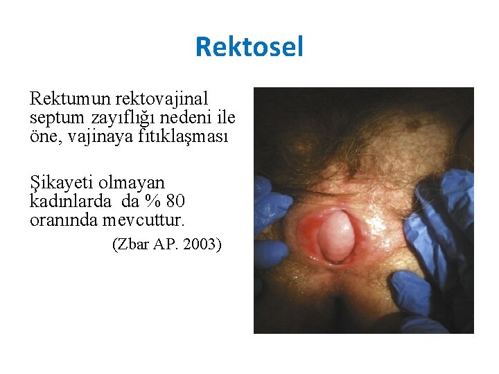 Rektosel Rektumun rektovajinal septum zayıflığı nedeni ile öne, vajinaya fıtıklaşması Şikayeti olmayan kadınlarda da Rektosel Rektumun rektovajinal septum zayıflığı nedeni ile öne, vajinaya fıtıklaşması Şikayeti olmayan kadınlarda da
