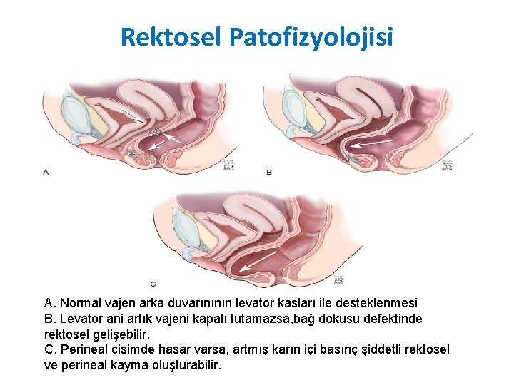 Rektosel Patofizyolojisi A. Normal vajen arka duvarınının levator kasları ile desteklenmesi B. Levator ani Rektosel Patofizyolojisi A. Normal vajen arka duvarınının levator kasları ile desteklenmesi B. Levator ani