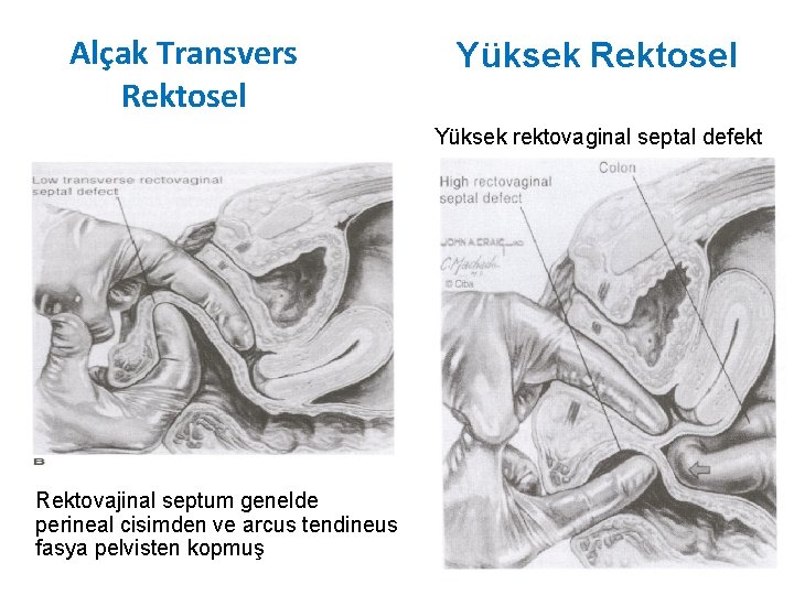 Alçak Transvers Rektosel Yüksek rektovaginal septal defekt Rektovajinal septum genelde perineal cisimden ve arcus Alçak Transvers Rektosel Yüksek rektovaginal septal defekt Rektovajinal septum genelde perineal cisimden ve arcus
