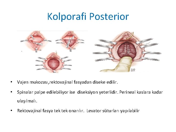 Kolporafi Posterior • Vajen mukozası, rektovajinal fasyadan diseke edilir. • Spinalar palpe edilebiliyor ise Kolporafi Posterior • Vajen mukozası, rektovajinal fasyadan diseke edilir. • Spinalar palpe edilebiliyor ise
