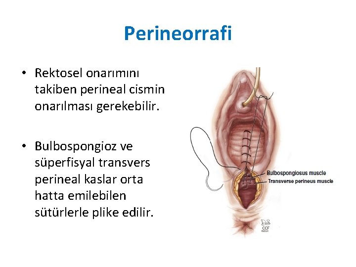 Perineorrafi • Rektosel onarımını takiben perineal cismin onarılması gerekebilir. • Bulbospongioz ve süperfisyal transvers Perineorrafi • Rektosel onarımını takiben perineal cismin onarılması gerekebilir. • Bulbospongioz ve süperfisyal transvers
