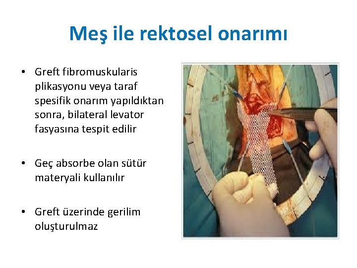 Meş ile rektosel onarımı • Greft fibromuskularis plikasyonu veya taraf spesifik onarım yapıldıktan sonra, Meş ile rektosel onarımı • Greft fibromuskularis plikasyonu veya taraf spesifik onarım yapıldıktan sonra,