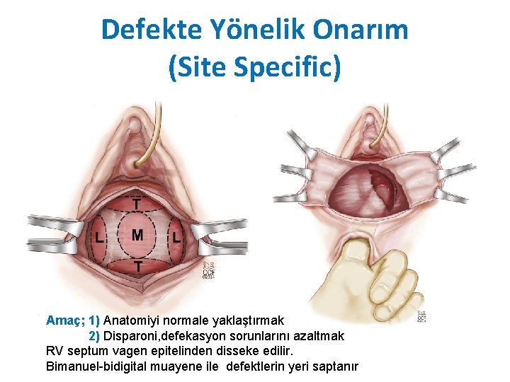 Defekte Yönelik Onarım (Site Specific) Amaç; 1) Anatomiyi normale yaklaştırmak 2) Disparoni, defekasyon sorunlarını Defekte Yönelik Onarım (Site Specific) Amaç; 1) Anatomiyi normale yaklaştırmak 2) Disparoni, defekasyon sorunlarını