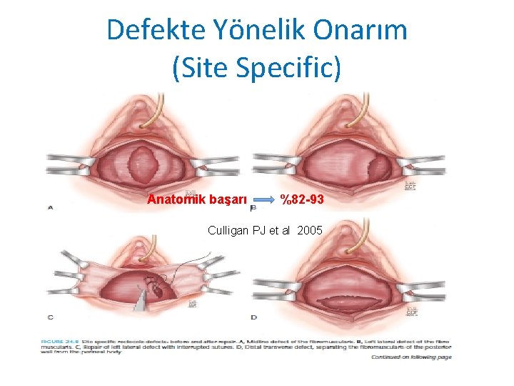 Defekte Yönelik Onarım (Site Specific) Anatomik başarı %82 -93 Culligan PJ et al 2005 Defekte Yönelik Onarım (Site Specific) Anatomik başarı %82 -93 Culligan PJ et al 2005