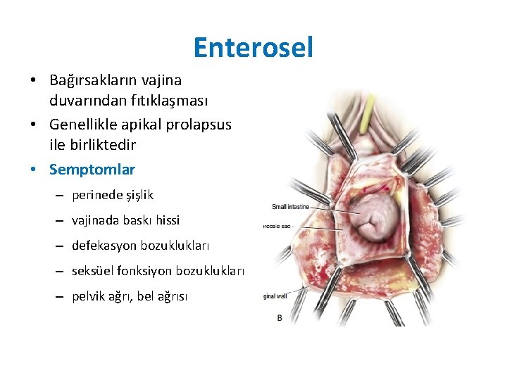 Enterosel • Bağırsakların vajina duvarından fıtıklaşması • Genellikle apikal prolapsus ile birliktedir • Semptomlar Enterosel • Bağırsakların vajina duvarından fıtıklaşması • Genellikle apikal prolapsus ile birliktedir • Semptomlar