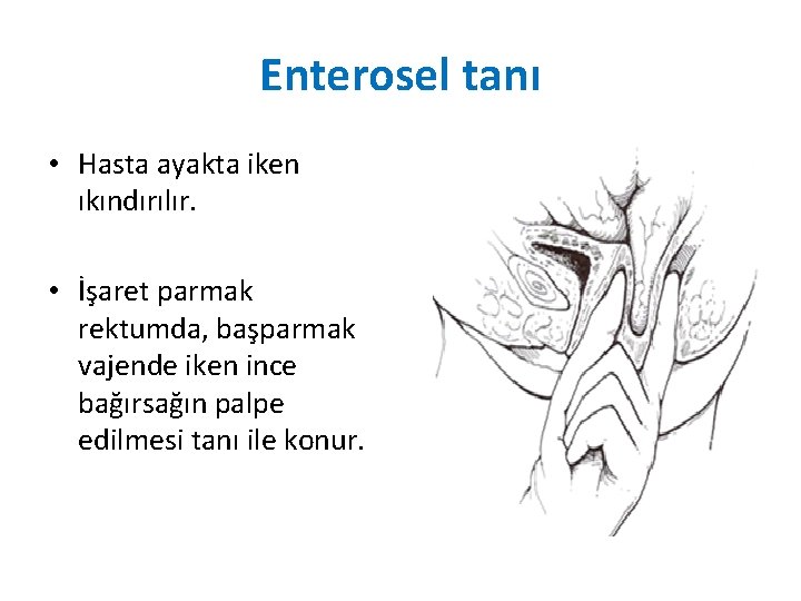 Enterosel tanı • Hasta ayakta iken ıkındırılır. • İşaret parmak rektumda, başparmak vajende iken Enterosel tanı • Hasta ayakta iken ıkındırılır. • İşaret parmak rektumda, başparmak vajende iken