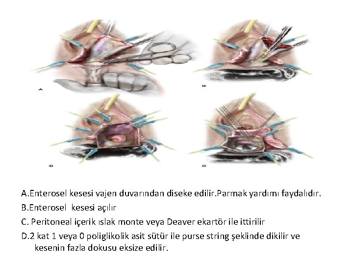 A. Enterosel kesesi vajen duvarından diseke edilir. Parmak yardımı faydalıdır. B. Enterosel kesesi açılır A. Enterosel kesesi vajen duvarından diseke edilir. Parmak yardımı faydalıdır. B. Enterosel kesesi açılır