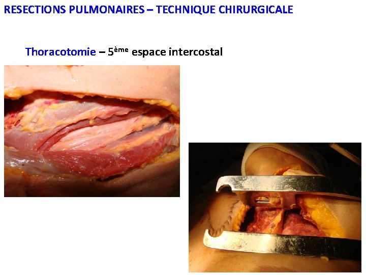 RESECTIONS PULMONAIRES – TECHNIQUE CHIRURGICALE Thoracotomie – 5ème espace intercostal 