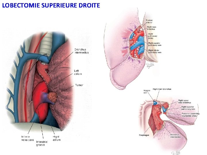 LOBECTOMIE SUPERIEURE DROITE 