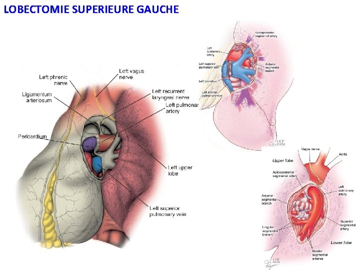 LOBECTOMIE SUPERIEURE GAUCHE 