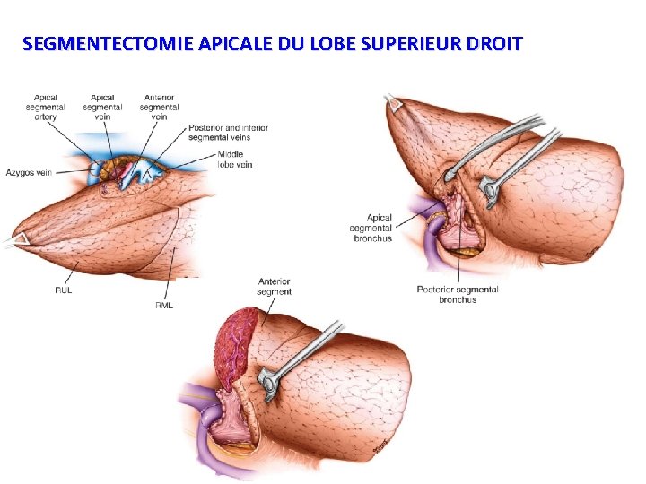 SEGMENTECTOMIE APICALE DU LOBE SUPERIEUR DROIT 