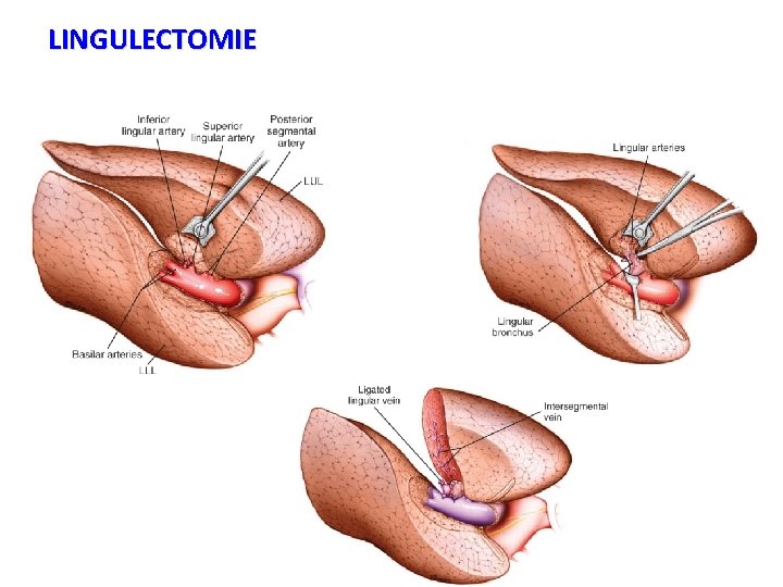 LINGULECTOMIE 