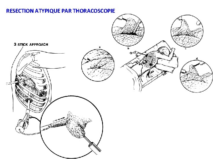 RESECTION ATYPIQUE PAR THORACOSCOPIE 