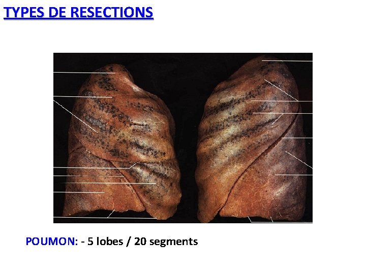 TYPES DE RESECTIONS POUMON: - 5 lobes / 20 segments 