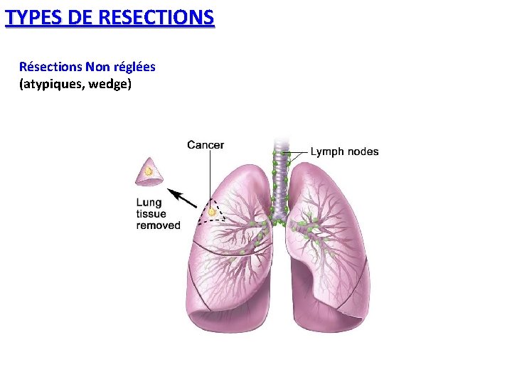 TYPES DE RESECTIONS Résections Non réglées (atypiques, wedge) 