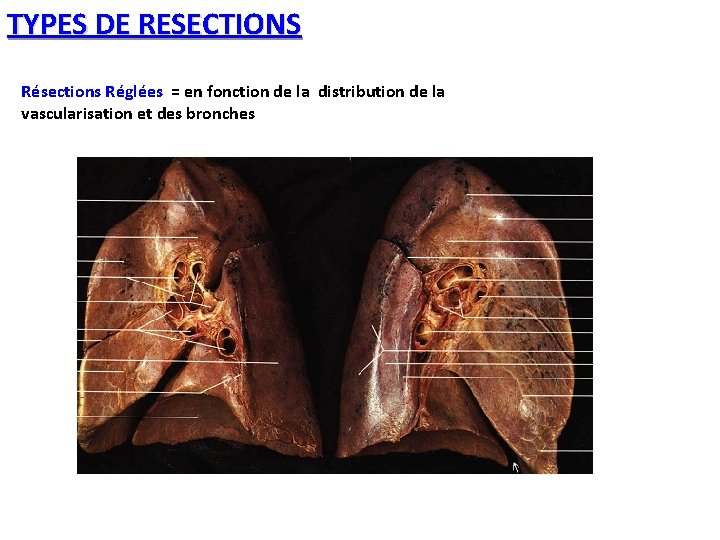 TYPES DE RESECTIONS Résections Réglées = en fonction de la distribution de la vascularisation