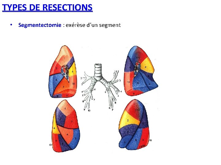 TYPES DE RESECTIONS • Segmentectomie : exérèse d’un segment 