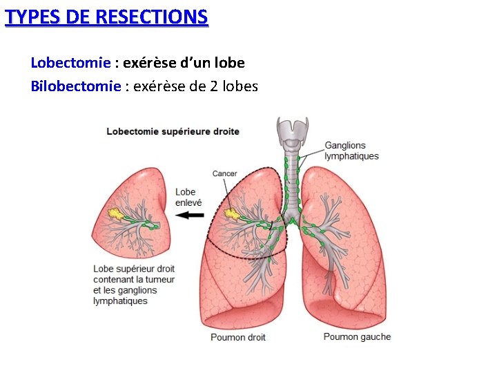 TYPES DE RESECTIONS Lobectomie : exérèse d’un lobe Bilobectomie : exérèse de 2 lobes