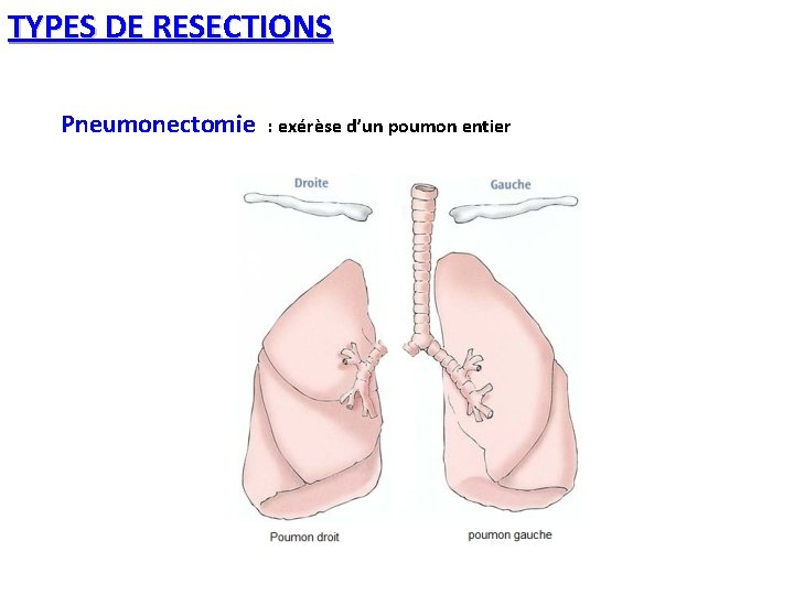 TYPES DE RESECTIONS Pneumonectomie : exérèse d’un poumon entier 