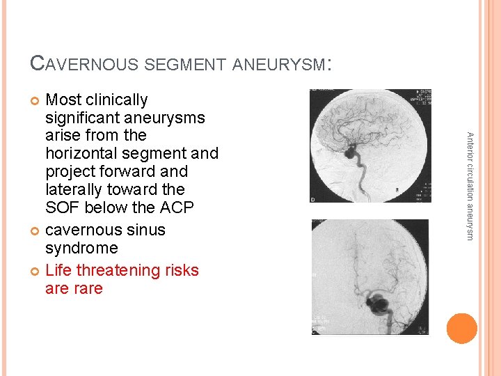 CAVERNOUS SEGMENT ANEURYSM: Most clinically significant aneurysms arise from the horizontal segment and project