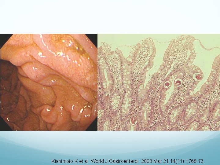 Kishimoto K et al. World J Gastroenterol. 2008 Mar 21; 14(11): 1768 -73. 