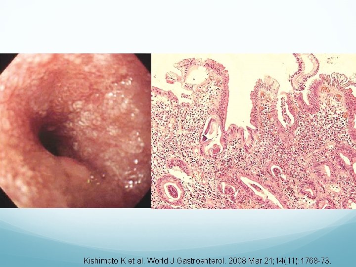 Kishimoto K et al. World J Gastroenterol. 2008 Mar 21; 14(11): 1768 -73. 