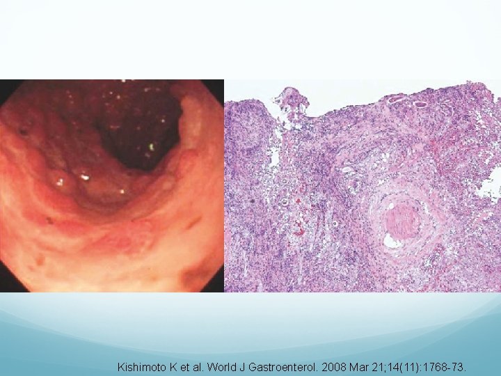 Kishimoto K et al. World J Gastroenterol. 2008 Mar 21; 14(11): 1768 -73. 