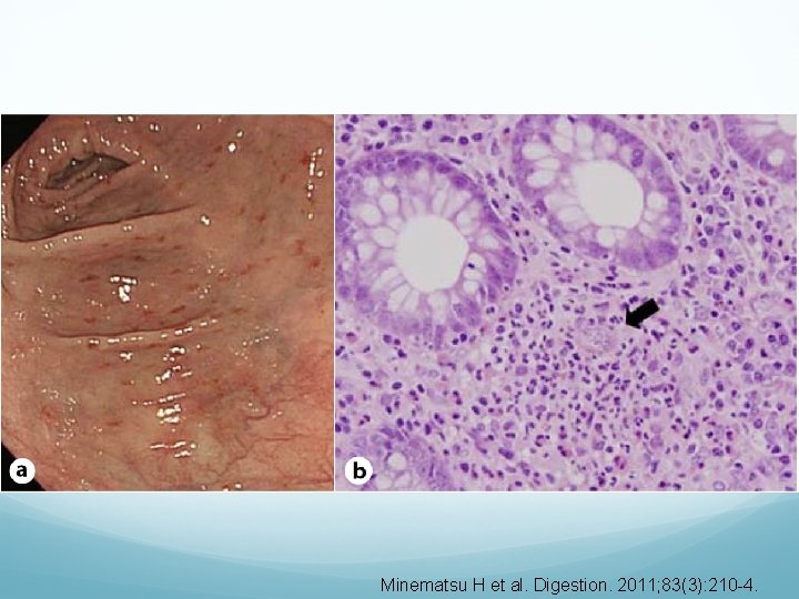 Minematsu H et al. Digestion. 2011; 83(3): 210 -4. 