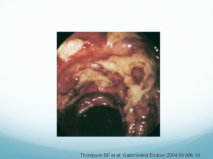 Thompson BF et al. Gastrointest Endosc 2004; 59: 906 -10. 