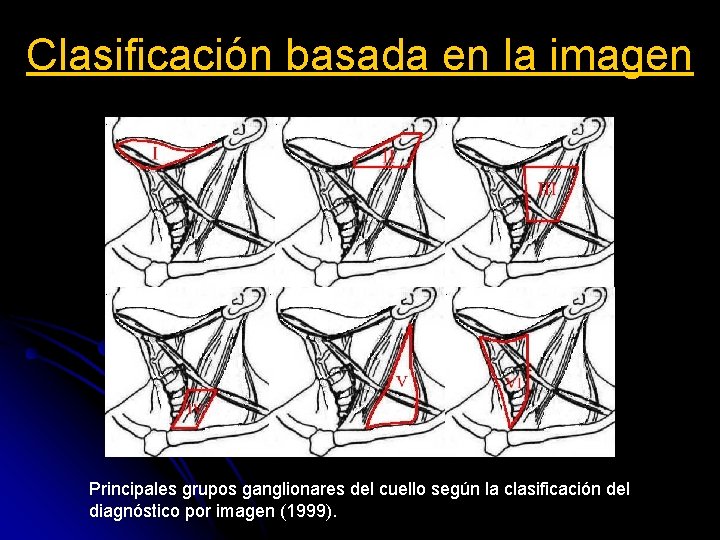 Clasificación basada en la imagen Principales grupos ganglionares del cuello según la clasificación del