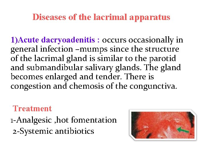 Diseases of the lacrimal apparatus 1)Acute dacryoadenitis : occurs occasionally in general infection –mumps