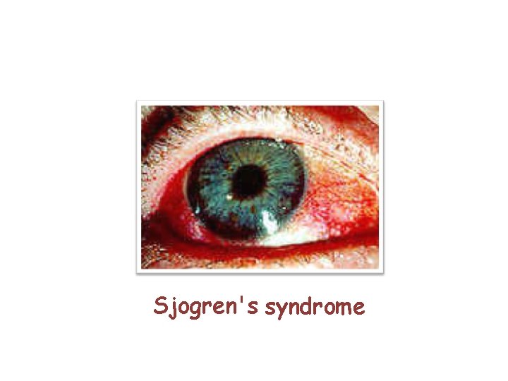 Sjogren's syndrome 