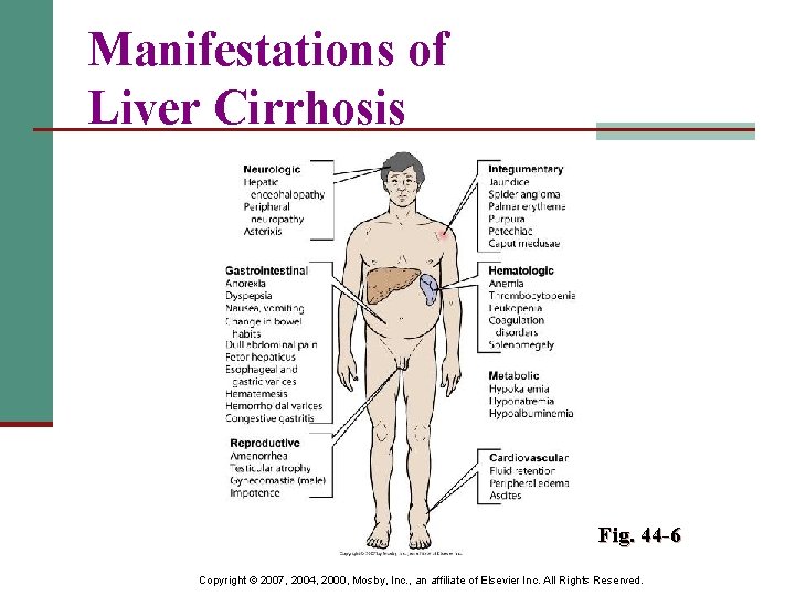 Manifestations of Liver Cirrhosis Fig. 44 -6 Copyright © 2007, 2004, 2000, Mosby, Inc.