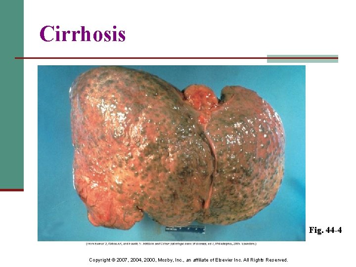 Cirrhosis Fig. 44 -4 Copyright © 2007, 2004, 2000, Mosby, Inc. , an affiliate