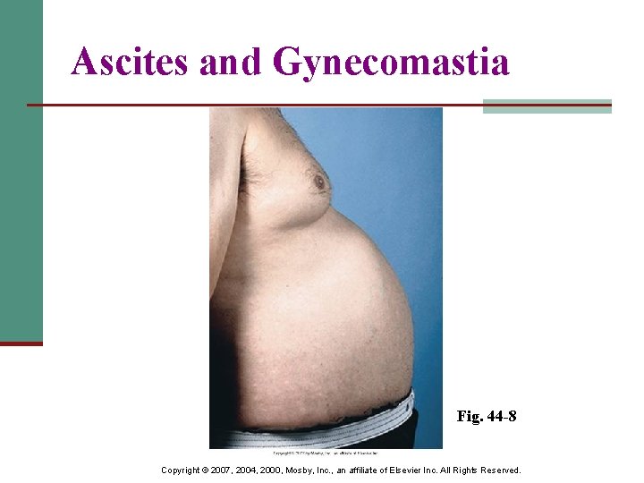 Ascites and Gynecomastia Fig. 44 -8 Copyright © 2007, 2004, 2000, Mosby, Inc. ,
