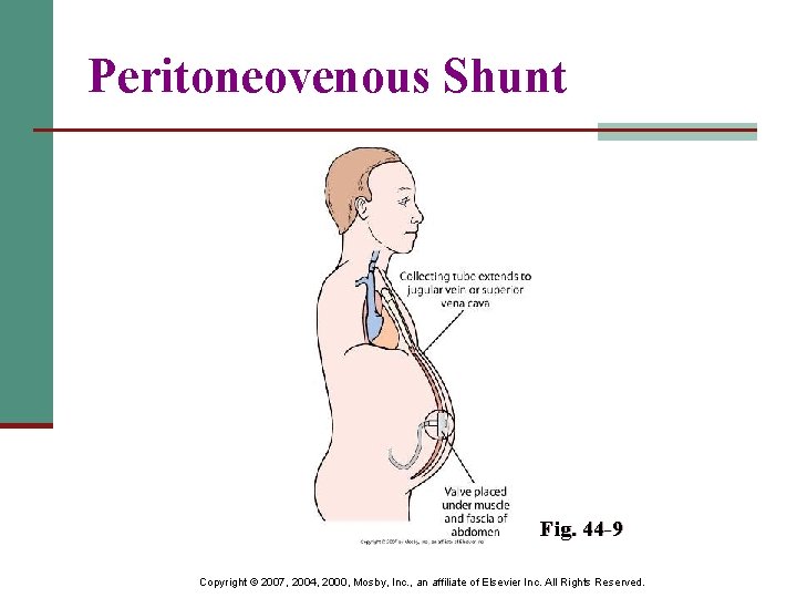 Peritoneovenous Shunt Fig. 44 -9 Copyright © 2007, 2004, 2000, Mosby, Inc. , an